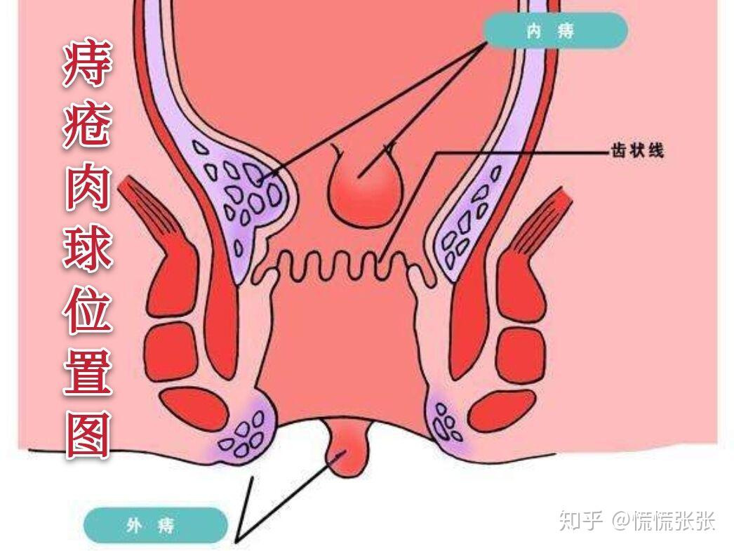 痔疮做手术多少钱