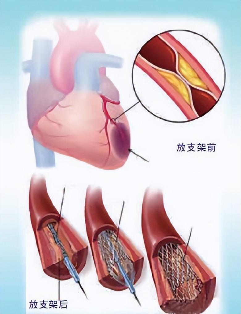 心脏支架后能活多少年